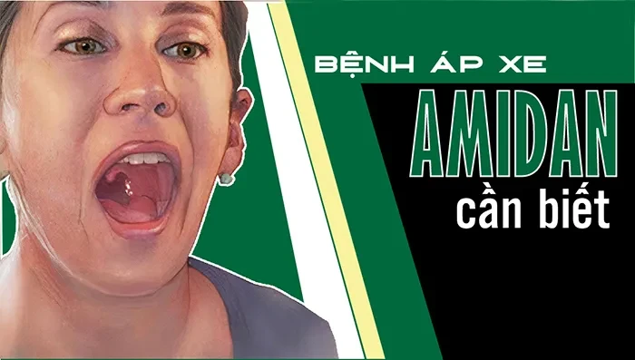 Bệnh áp xe amidan cần biết