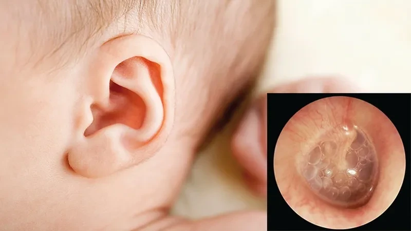 Tại sao điều trị viêm tai giữa thường kéo dài nhiều tuần?