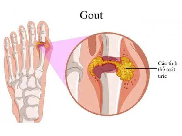 Bộ phận trong cơ thể dễ tổn thương do axit uric cao