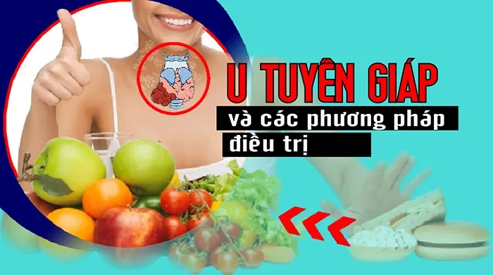 U tuyến giáp và các phương pháp điều trị