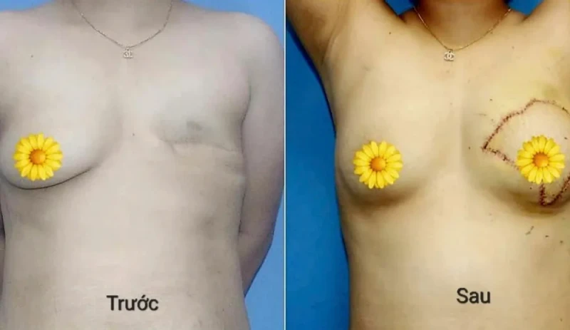 Phẫu thuật tái tạo vú sau cắt bỏ ung thư đem lại sự tự tin cho người bệnh