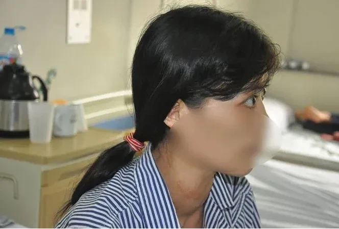 Cảnh báo trường hợp tự ý dùng thuốc hormon tuyến giáp Berlthyrox trị bệnh basedow dẫn đến biến chứng nguy hiểm