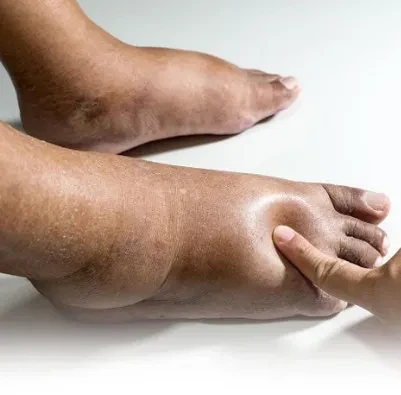 Phù tay chân hay phù toàn thân là dấu hiệu của bệnh lý gì?