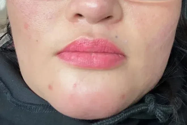 Nhiều trường hợp biến chứng sau tiêm filler để làm đẹp