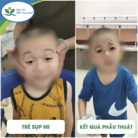 Nguyên nhân, biện pháp và cách điều trị sụp mi