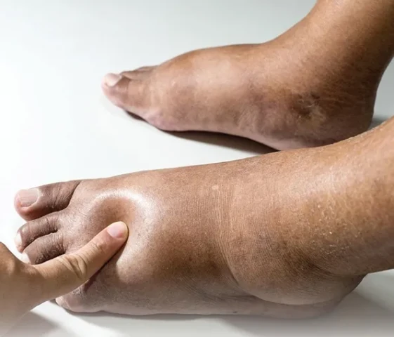 Suy tim cấp: Những điều cần biết