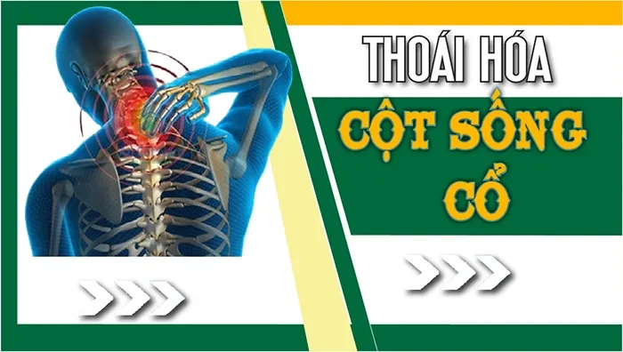 Thoái hóa cột sống cổ