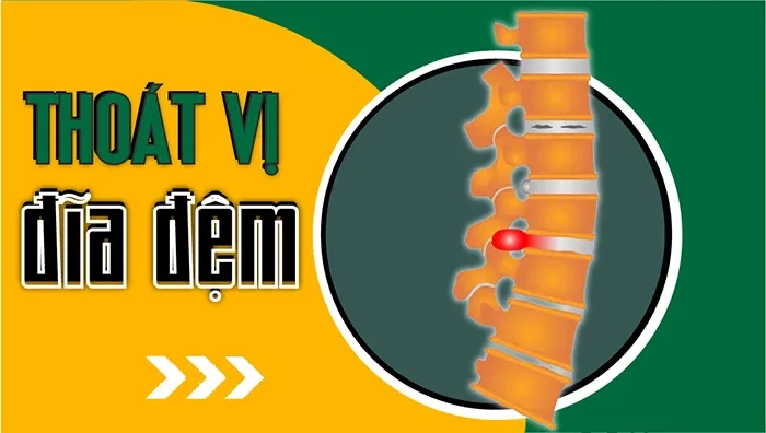 Thoát vị đĩa đệm