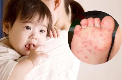Các dấu hiệu nặng cần nhập viện của trẻ em mắc bệnh tay chân miệng