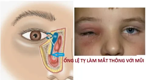 Tại sao viêm mũi xoang lại ảnh hưởng tới mắt?