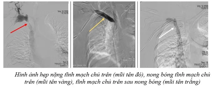 Hà Nội can thiệp mạch thành công cho bệnh nhân bị hẹp tĩnh mạch chủ trên có giải phẫu bất thường