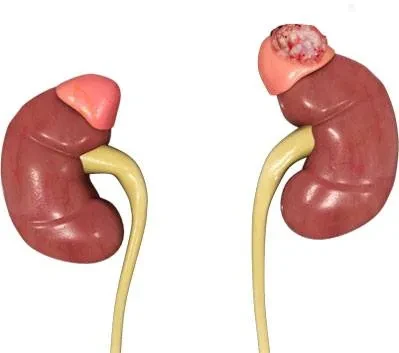 Bệnh nhân suy tuyến thượng thận cần biết