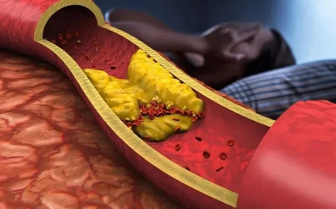 Thói quen xấu có thể gây nhồi máu não ở người trung niên