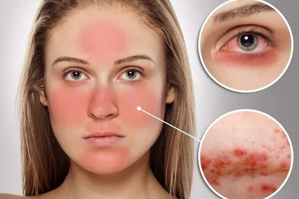 Bệnh Lupus ban đỏ hệ thống: Một số điều cần biết