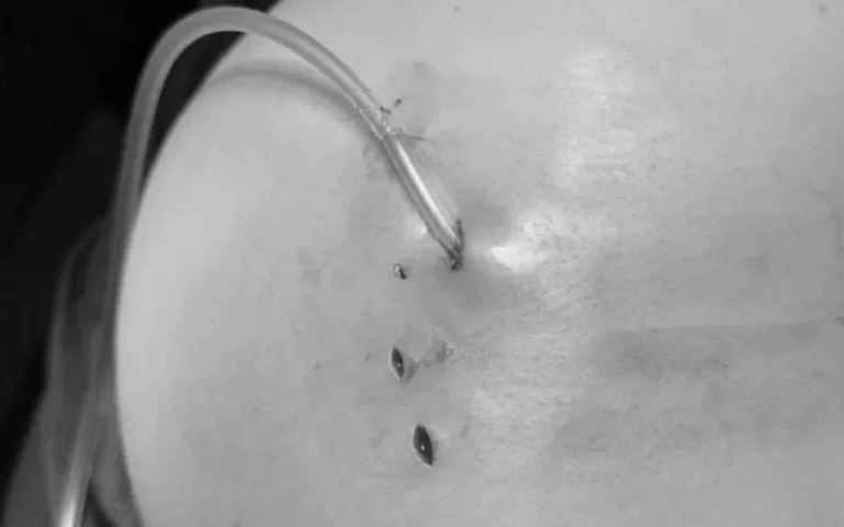 Điều trị cho 1 bệnh nhân bị biến chứng sau khi tiêm filler vào vùng mông