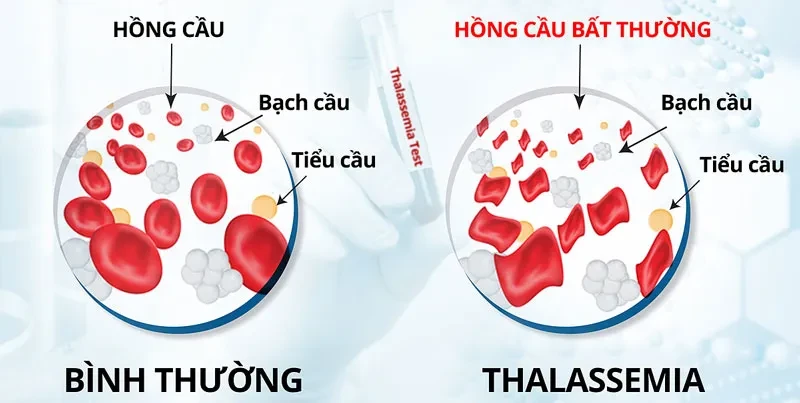 Thalassemia là bệnh gì?