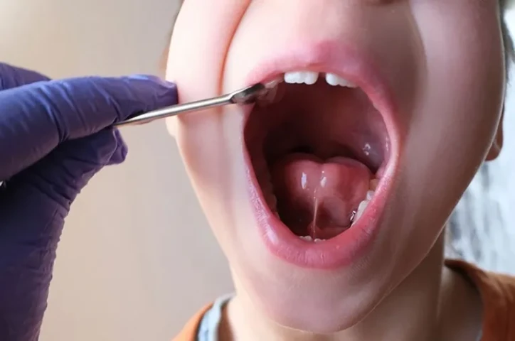 Phát hiện và can thiệp sớm trẻ dính phanh lưỡi