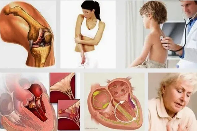 Tìm hiểu về bệnh thấp tim (ARF)