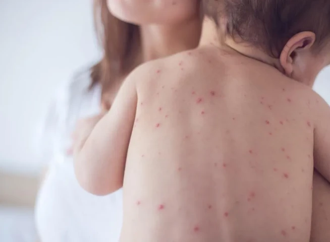 Bộ Y tế yêu cầu tăng cường phòng và kiểm soát lây nhiễm sởi trong cơ sở khám bệnh, chữa bệnh