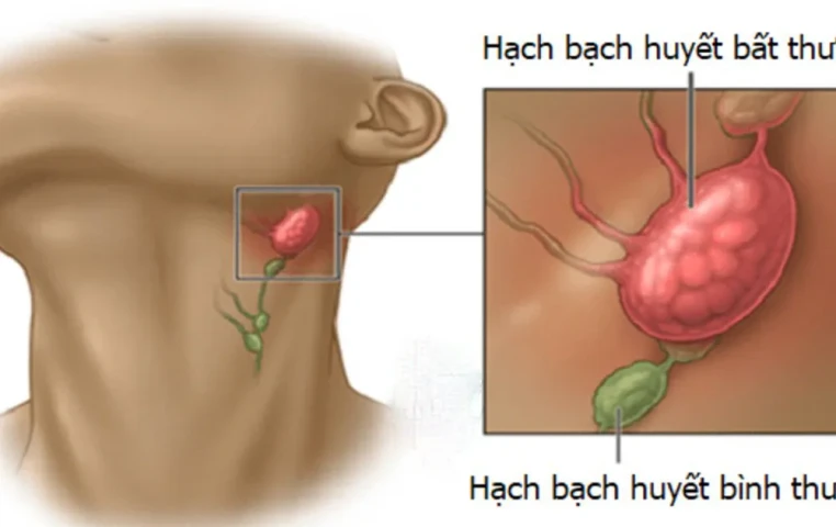 Siêu âm chẩn đoán hạch bạch huyết