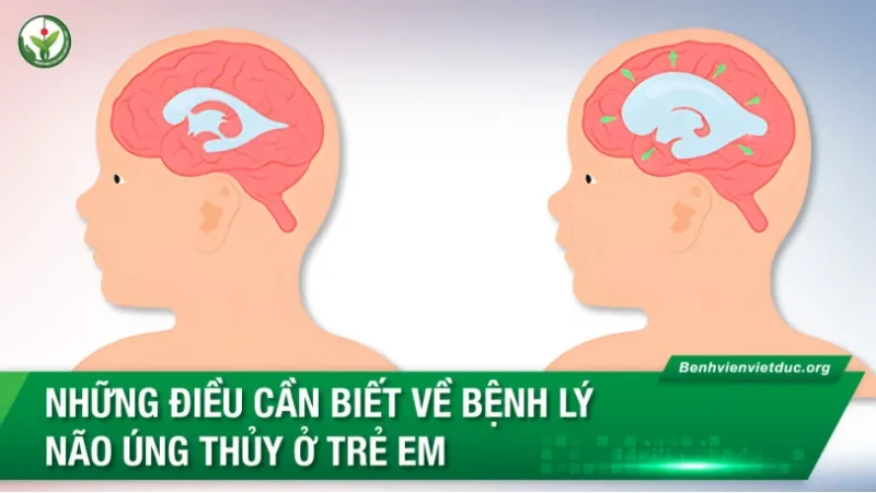 Những điều cần biết về bệnh lý não úng thủy ở trẻ em