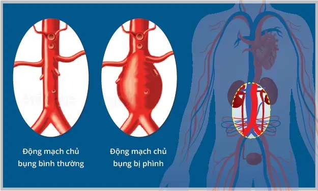 Phình động mạch chủ bụng và những dấu hiệu cảnh báo