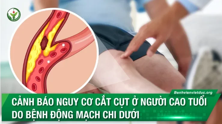 Cảnh báo nguy cơ, cách phát hiện sớm và phòng ngừa hoại tử chi dẫn đến cắt cụt ở người cao tuổi do bệnh động mạch chi dưới