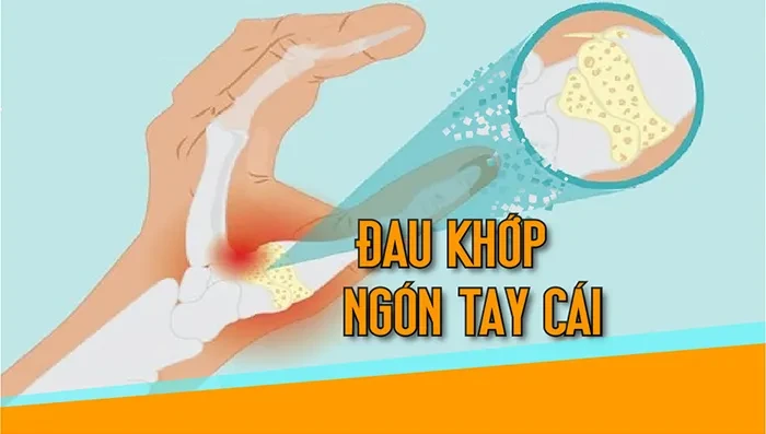Đau khớp ngón tay cái