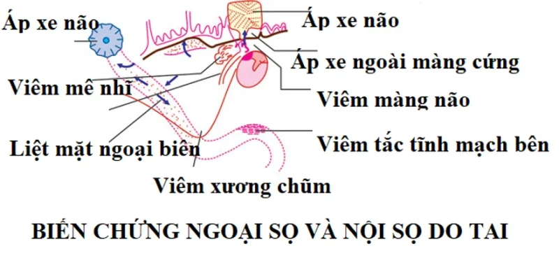 Phát hiện sớm các biến chứng từ bệnh lý viêm tai giữa