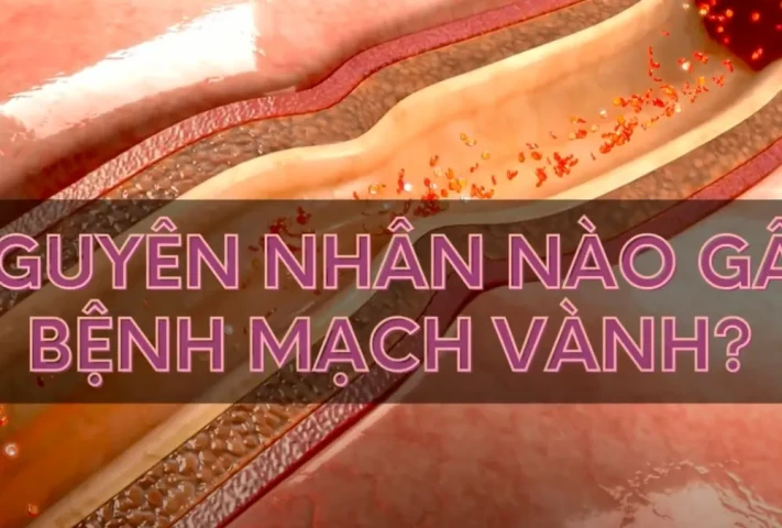 Nguyên nhân gây bệnh mạch vành?
