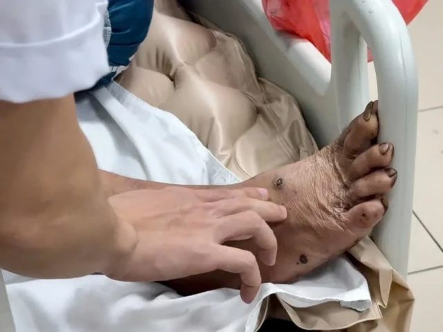Hy hữu người đàn ông mắc uốn ván chỉ vì gạch rơi vào chân