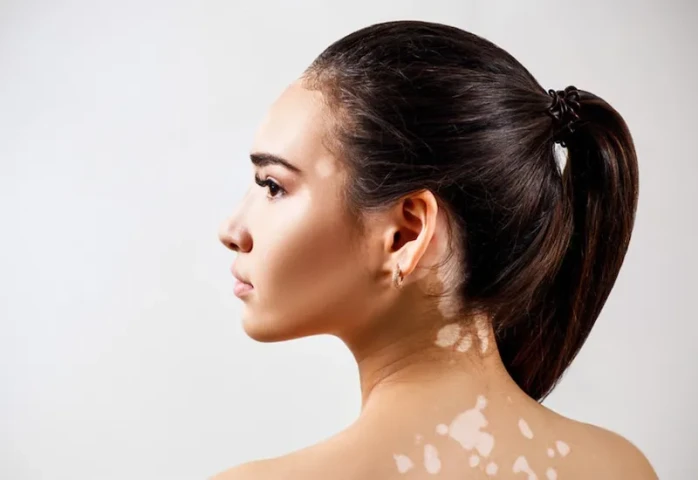 Hiệu quả điều trị bệnh bạch biến bằng Nam y