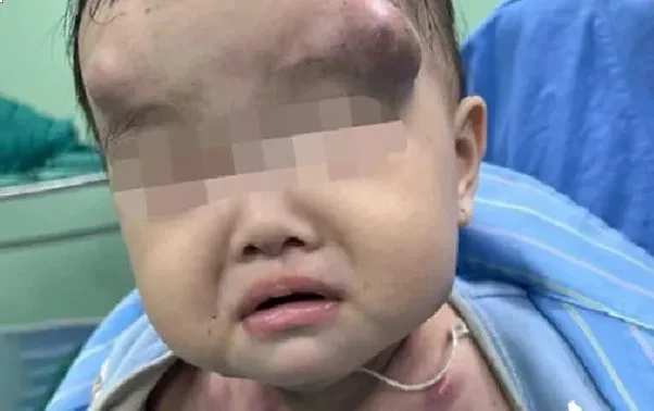 Nghệ An: Điều trị cho bé 1 tuổi bị nhiều khối ổ mủ trên khuôn mặt