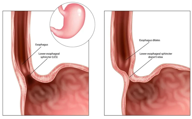 Co thắt tâm vị và những điều cần biết