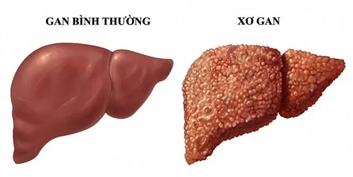 Các phương pháp giúp chẩn đoán tình trạng xơ gan