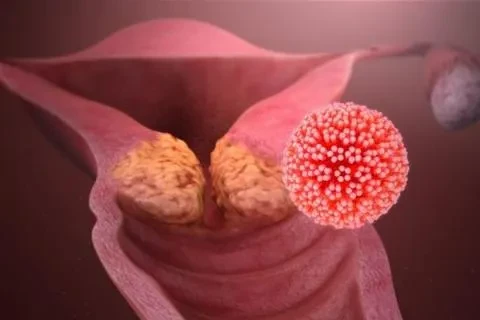 HPV và tầm soát ung thư cổ tử cung