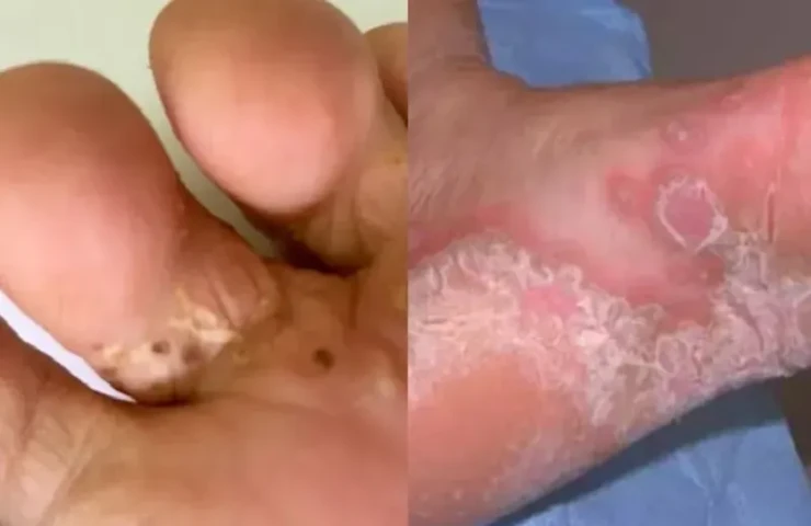 Cảnh báo nguy cơ bỏng do nước nóng, hóa chất, bỏng điện do chập cháy trong mùa bão