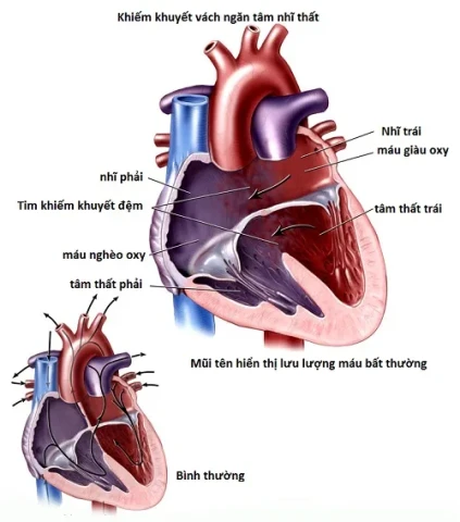 Những điều cần biết về thông sàn nhĩ thất