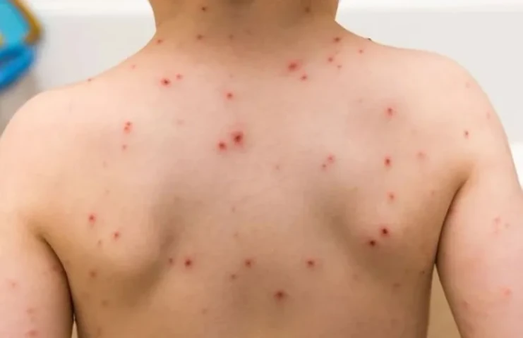 Bộ Y tế yêu cầu tăng cường công tác phòng chống bệnh Sởi