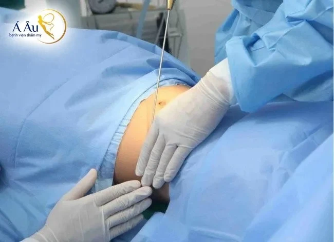 Hủy mỡ lipo nano 5.0 rút sạch mỡ thừa, siết gọn vòng eo sau 90 phút