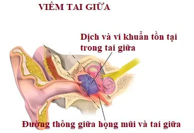 Vì sao viêm tai giữa hay bị tái lại nhiều lần?