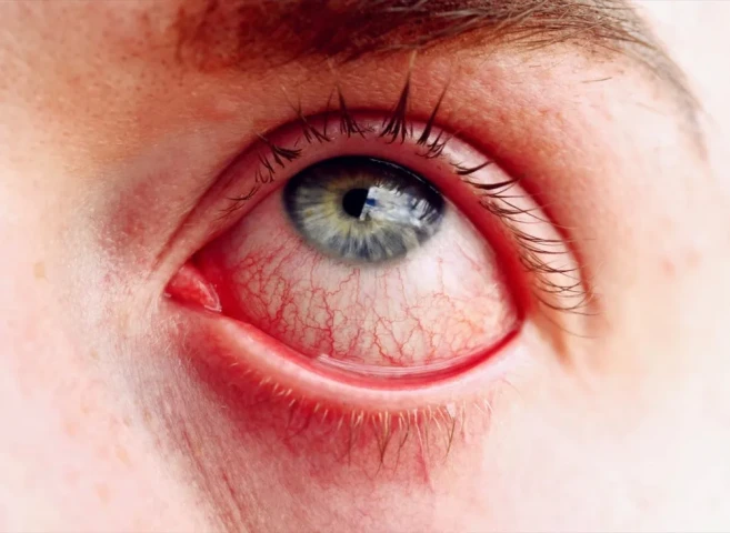3 cách điều trị đau mắt đỏ