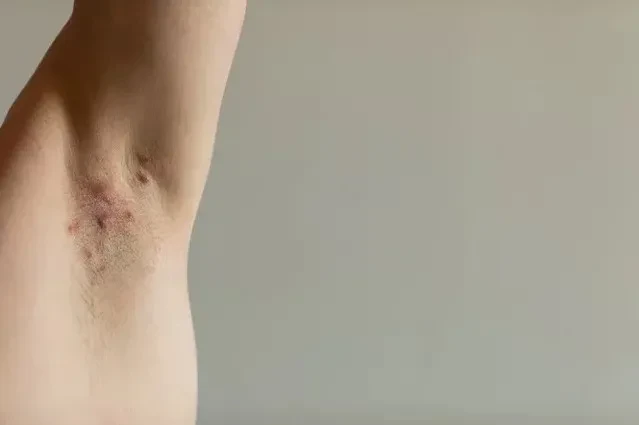 Triệu chứng, nguyên nhân và cách điều trị viêm nang lông