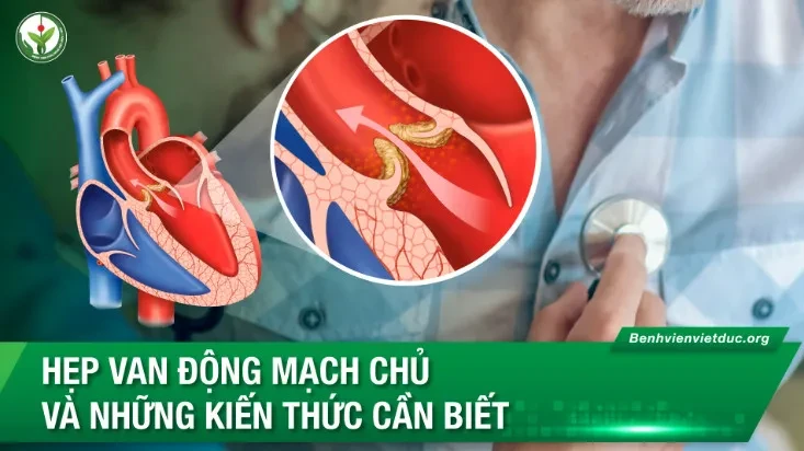 Hẹp van động mạch chủ và những kiến thức cần biết