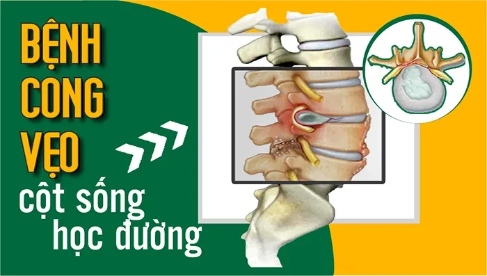 Bệnh cong vẹo cột sống học đường