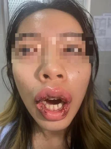 Nhiễm trùng, biến dạng môi chỉ vì làm đẹp