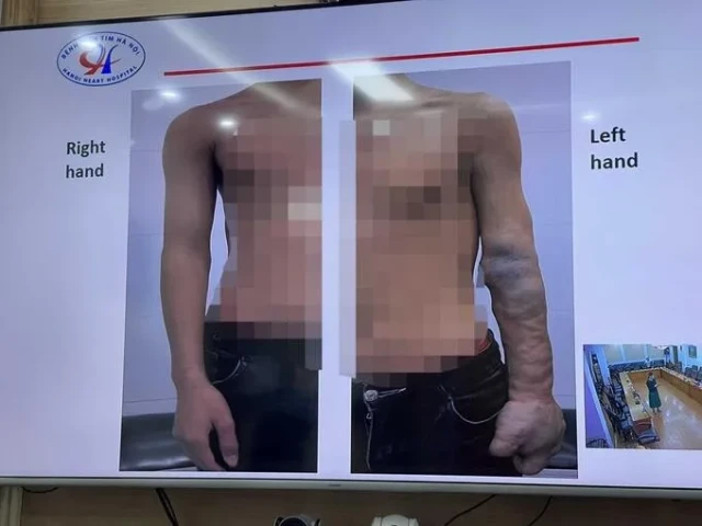 Bệnh viện tim Hà Nội can thiệp thành công bệnh lý mạch máu ngoại biên một bệnh nhân 17 năm không tìm ra bệnh