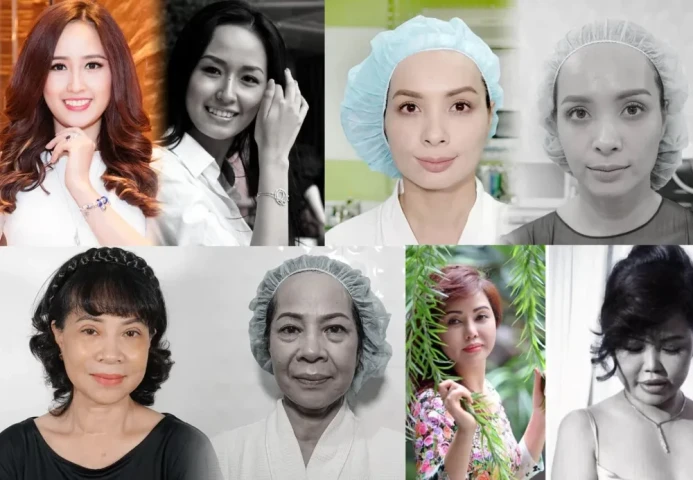 Giải mã hiệu quả vượt trội của liệu pháp căng da chỉ vàng 24K tại Bệnh viện Thẩm mỹ Á Âu