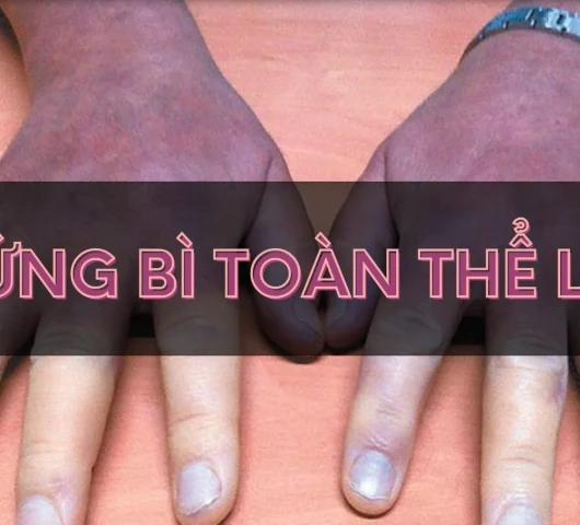 Xơ cứng bì toàn thể là gì?