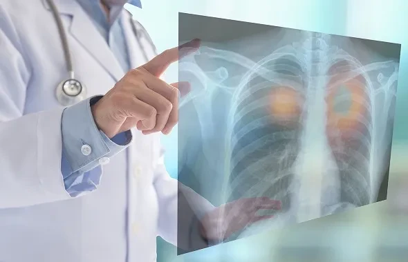 Tầm soát ung thư phổi